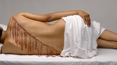 woman's back with stitched up large scar with red beads hanging form it 