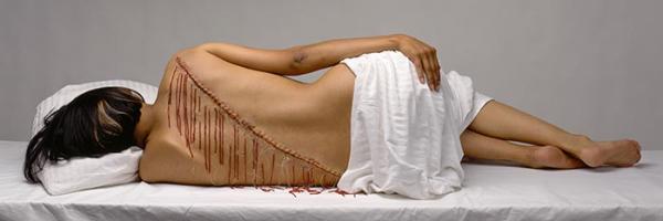 woman's back with stitched up large scar with red beads hanging form it 